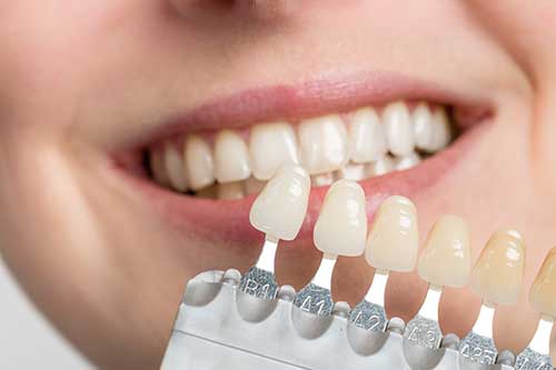 Dental Veneers | Columbia Smiles Dentistry | Columbia, Maryland